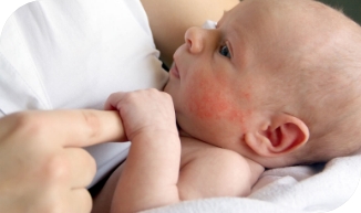 eczema in babies