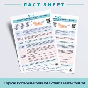 topical steroid cream for eczema fact sheet